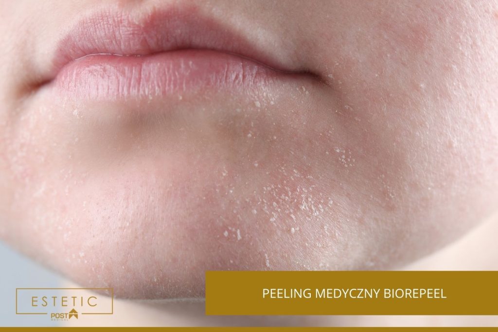 Peeling medyczny Biorepeel - zabieg ESTETIC by POST MEDICAL